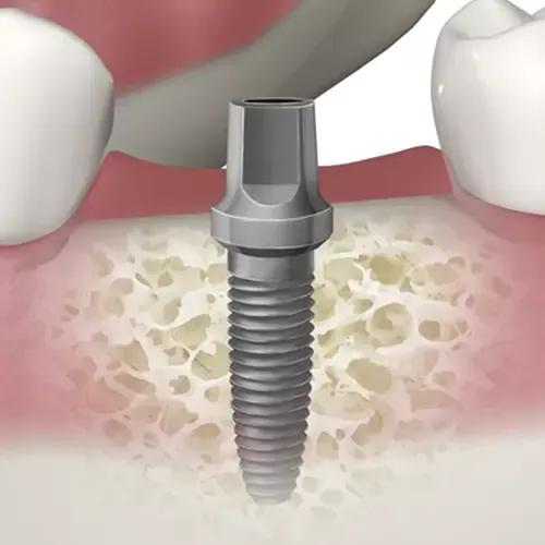 implant educational video