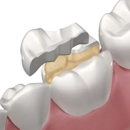 inlay educational video