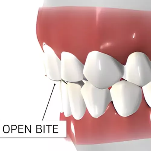 ortho open bite dental model image