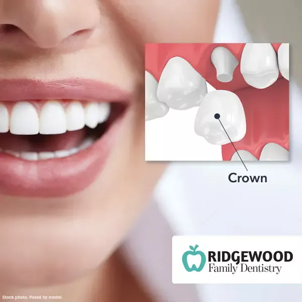 Sample social media post - dental crown