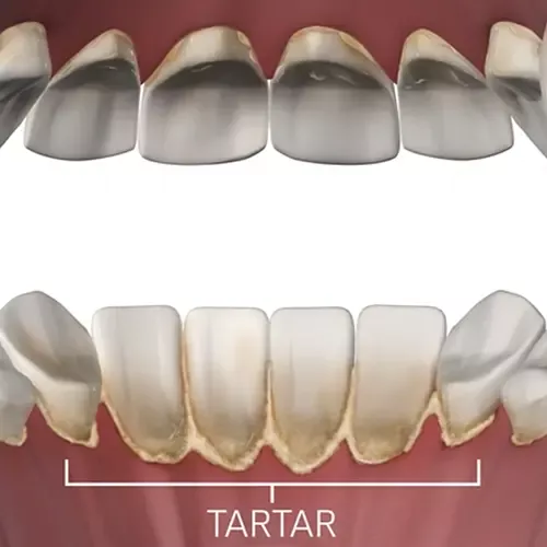 scaling educational videos showing tartar