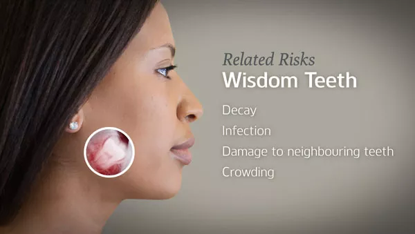 Slide from wisdom teeth video